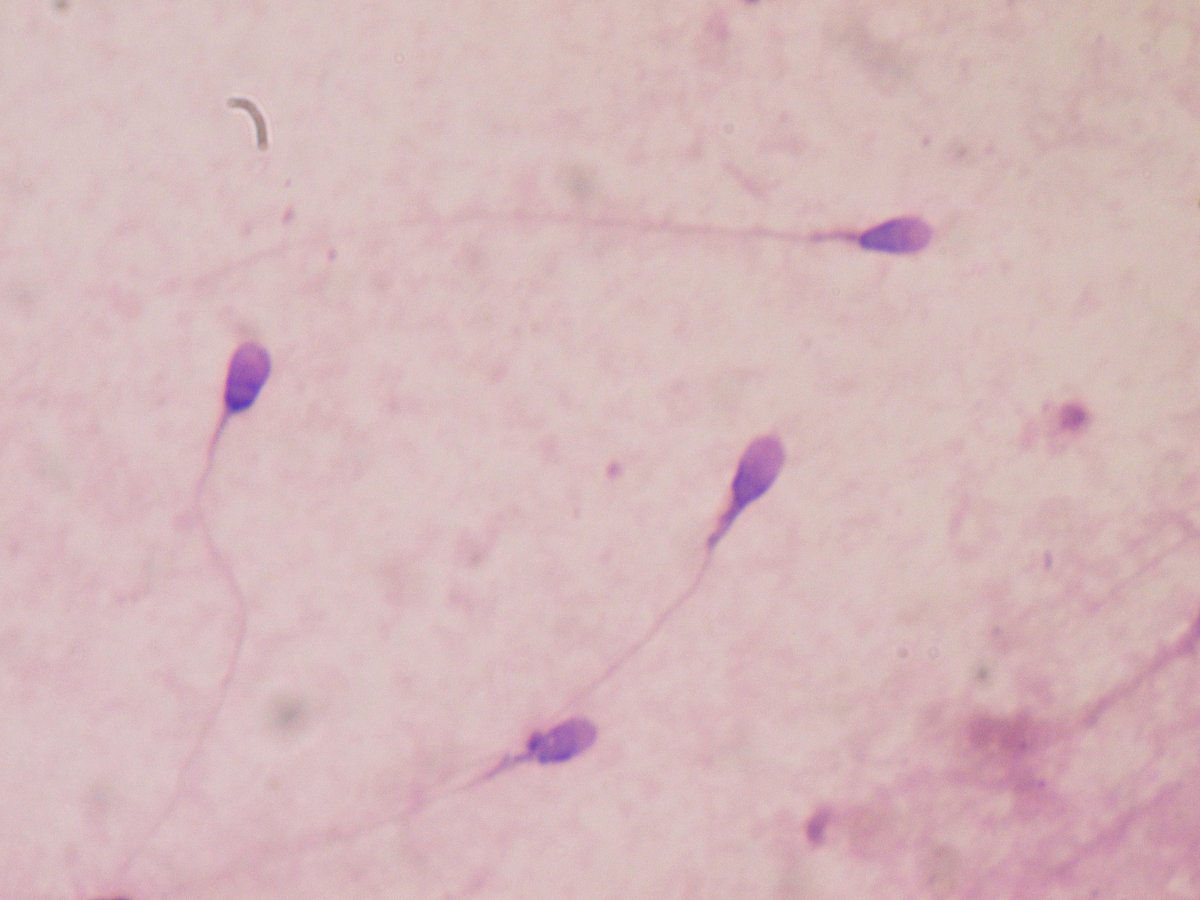 Espermatozoides humanos teñidos para valorar su forma, tal como se ven en el laboratorio.