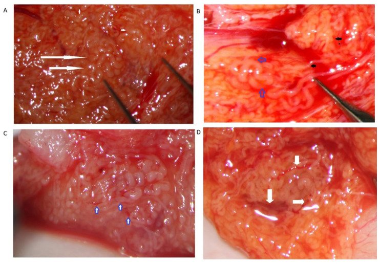 Micro-TESE vista con el microscopio quirúrgico: las flechas señalan los túbulos más gruesos, los que tienen más probabilidad de contener espermatozoides.